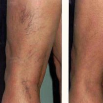 Sclerotherapy before and after