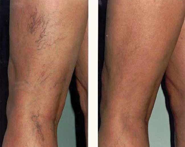 Sclerotherapy before and after