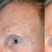 Actinic Keratosis Before and After