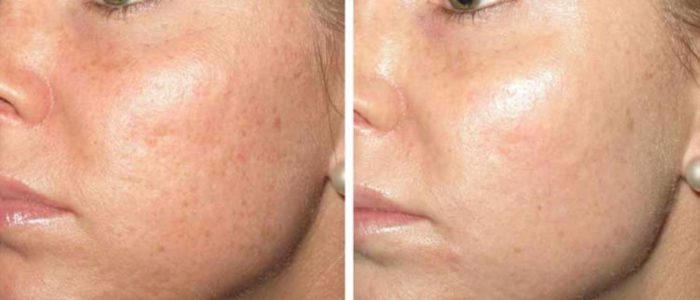 IPL Laser Before and After