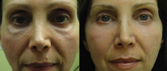 Volumizing Face Filler Before and After