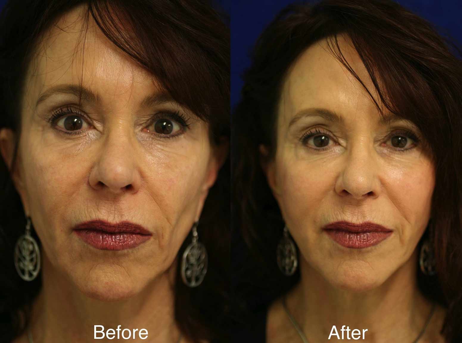 Volumizing Face Fillers Before and After