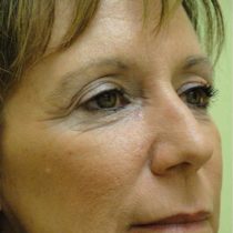 Wrinkle Relaxers after