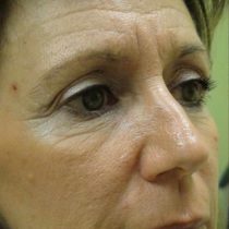 Wrinkle Relaxers before