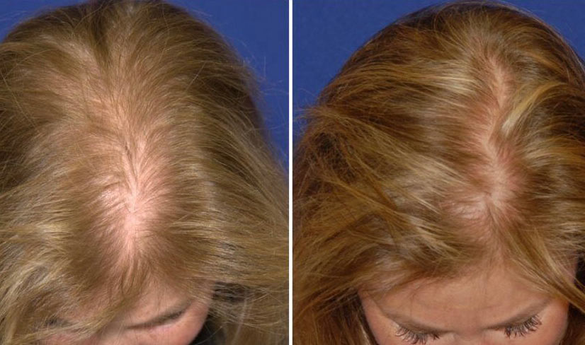PRP Hair Restoration Asheville