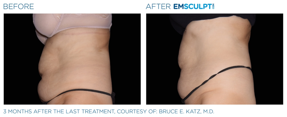 Emsculpt before and after abdomen — medAge Asheville