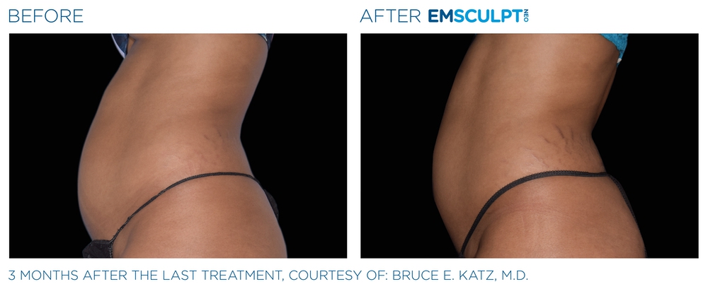 Emsculpt before and after abdomen — medAge Asheville