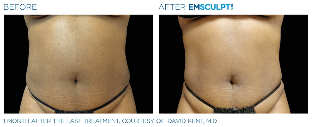 Emsculpt before and after abdomen — medAge Asheville