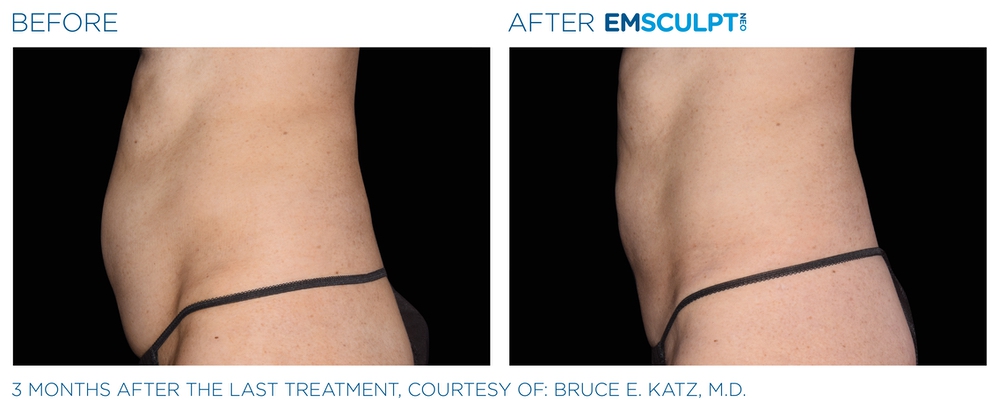 Emsculpt before and after abdomen — medAge Asheville