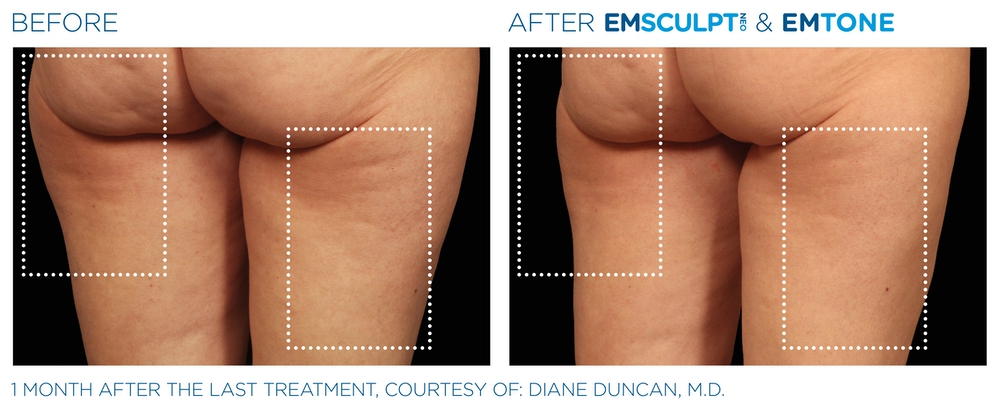 Emsculpt before and after thighs — medAge Asheville