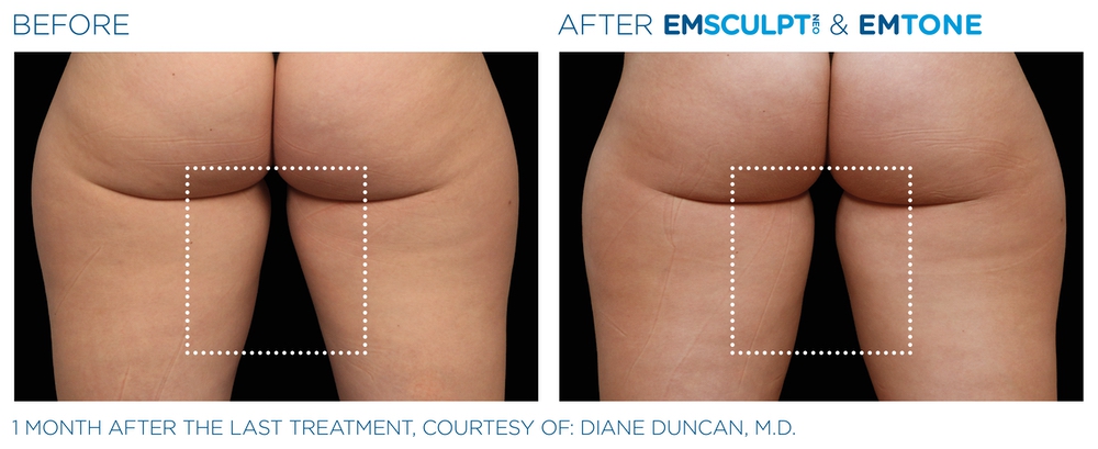Emsculpt before and after thighs — medAge Asheville