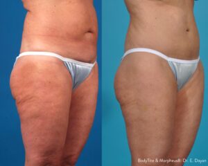 bodytite-morpheus8-before-after-dr-e-dayan-preview-1