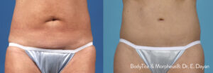 bodytite-morpheus8-before-after-dr-e-dayan-preview-2