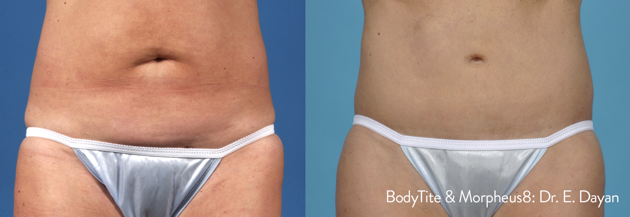 BodyTite before and after results — medAge Asheville