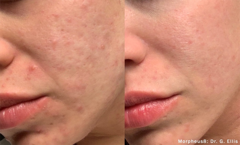 Morpheus8 before and after results — medAge Asheville patient 10