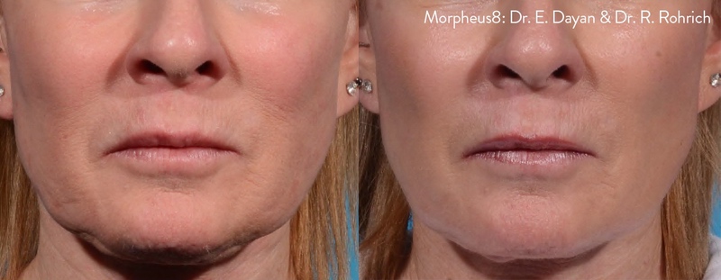 Morpheus8 before and after results — medAge Asheville patient 12