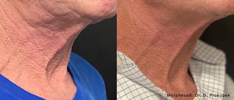 Morpheus8 before and after results — medAge Asheville patient 13