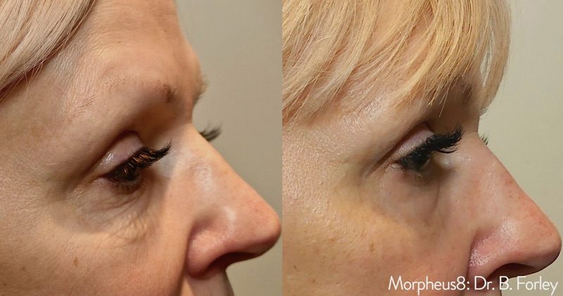 Morpheus8 before and after results — medAge Asheville patient 15