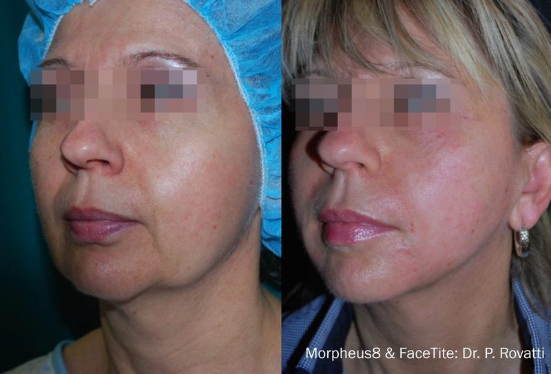Morpheus8 before and after results — medAge Asheville patient 19
