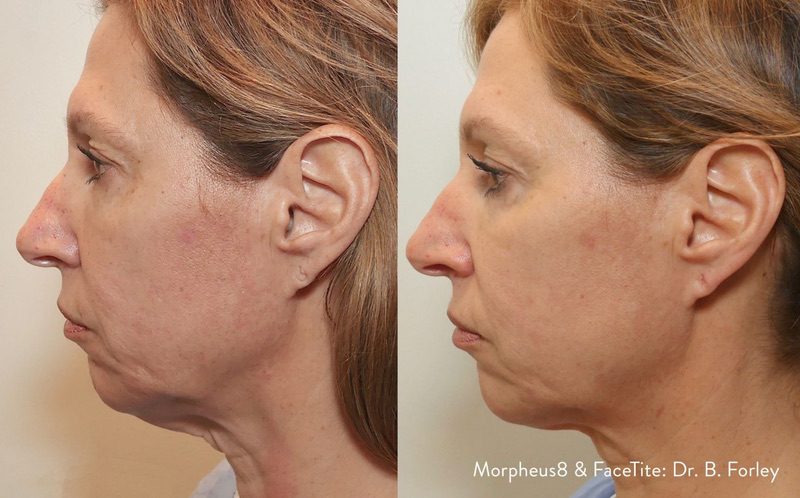Morpheus8 before and after results — medAge Asheville patient 20