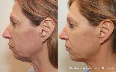 Morpheus8 before and after results — medAge Asheville patient 21