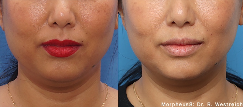 Morpheus8 before and after results — medAge Asheville patient 24