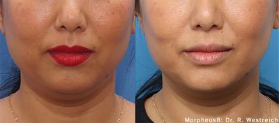 Morpheus8 before and after results — medAge Asheville patient 25