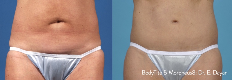 Morpheus8 before and after results — medAge Asheville patient 27