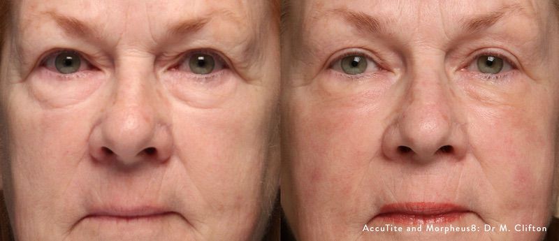 Morpheus8 before and after results — medAge Asheville patient 28