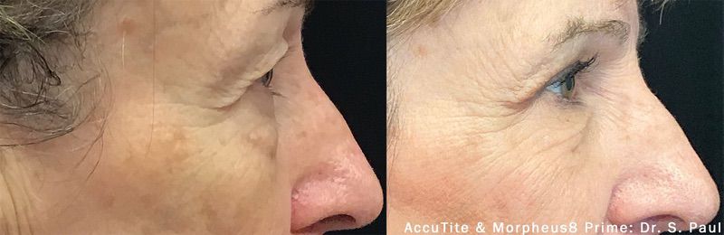 Morpheus8 before and after results — medAge Asheville patient 29