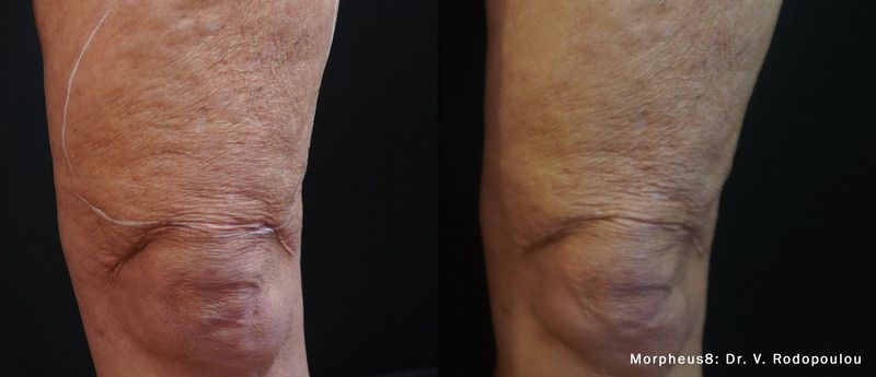 Morpheus8 before and after results — medAge Asheville patient 3