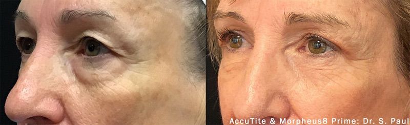 Morpheus8 before and after results — medAge Asheville patient 30