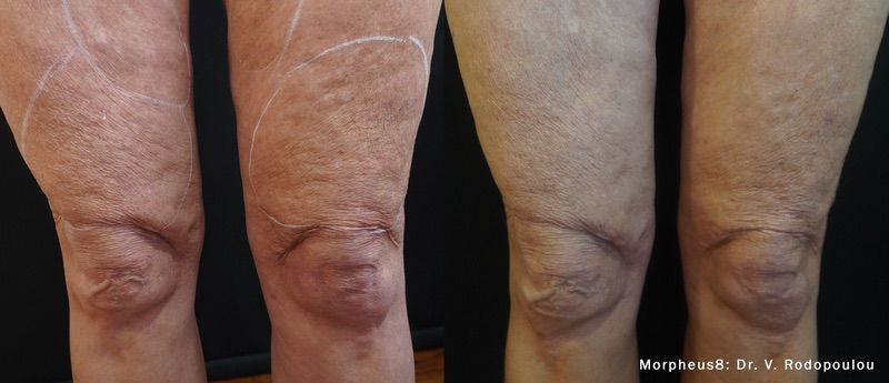 Morpheus8 before and after results — medAge Asheville patient 7
