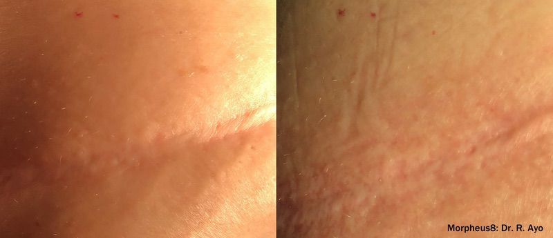 Morpheus8 before and after results — medAge Asheville patient 9
