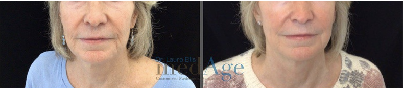 FaceTite before and after — medAge Asheville patient