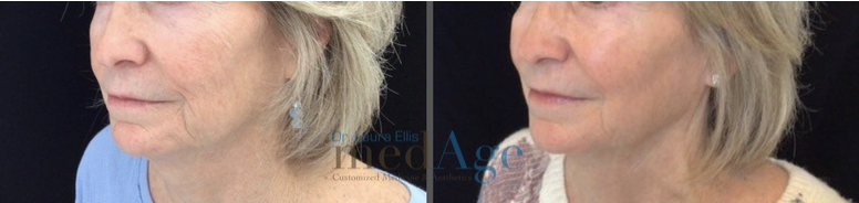 FaceTite before and after — medAge Asheville patient