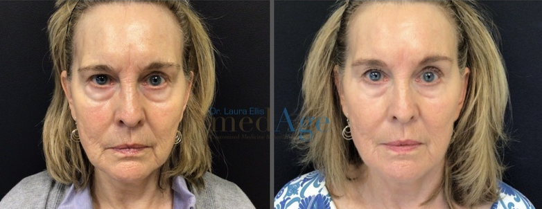 FaceTite before and after — medAge Asheville patient