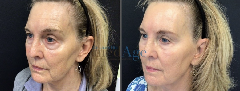 FaceTite before and after — medAge Asheville patient