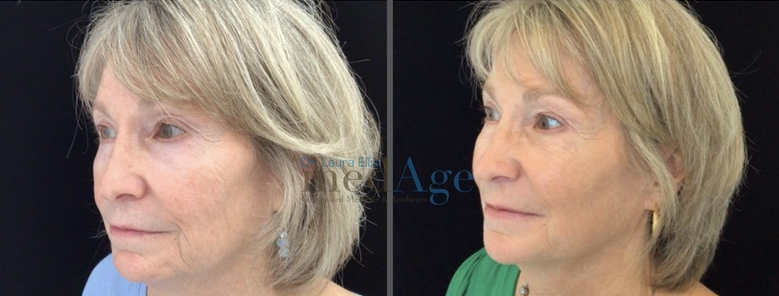 FaceTite before and after — medAge Asheville patient