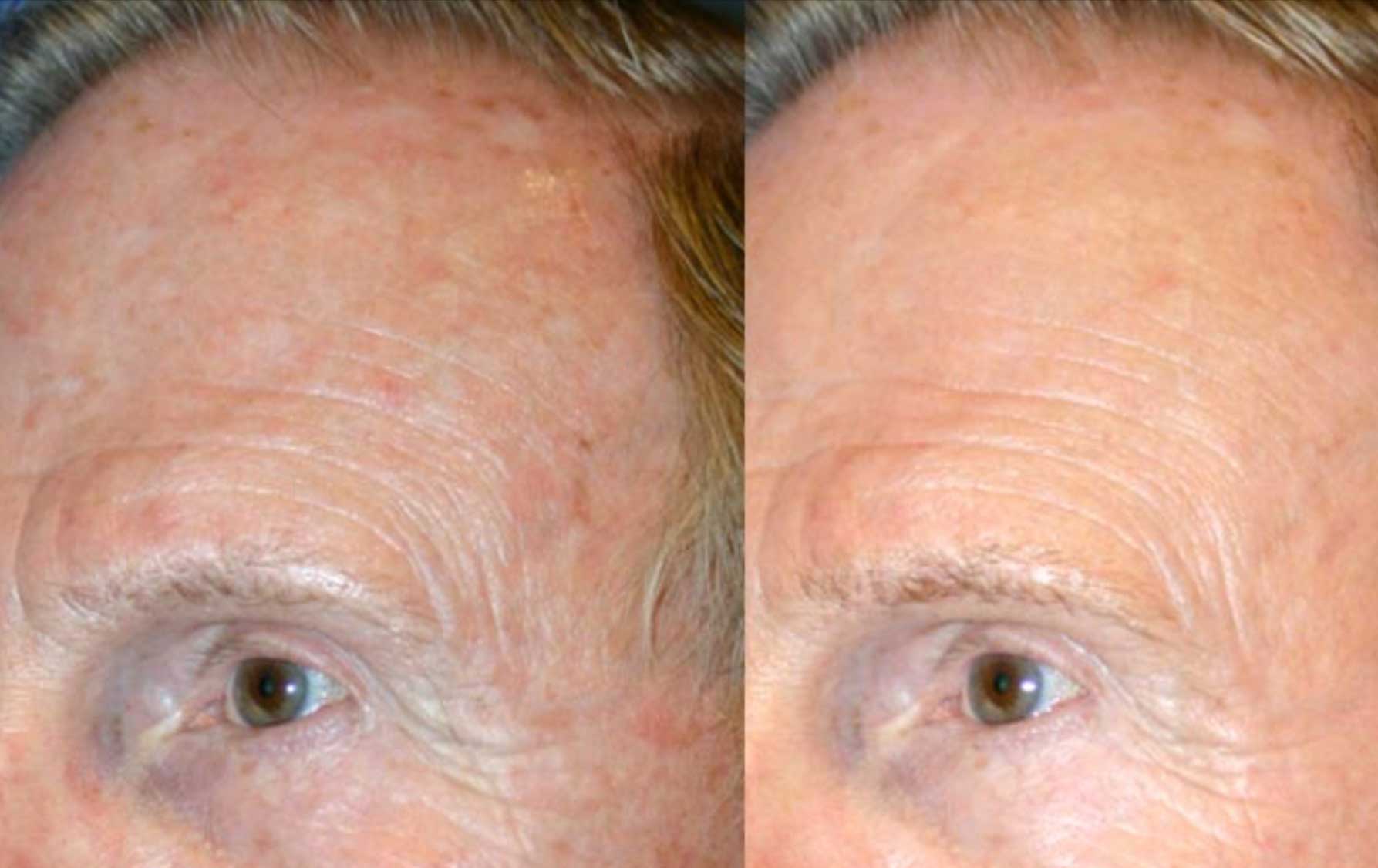 Photodynamic therapy before and after — medAge Asheville patient