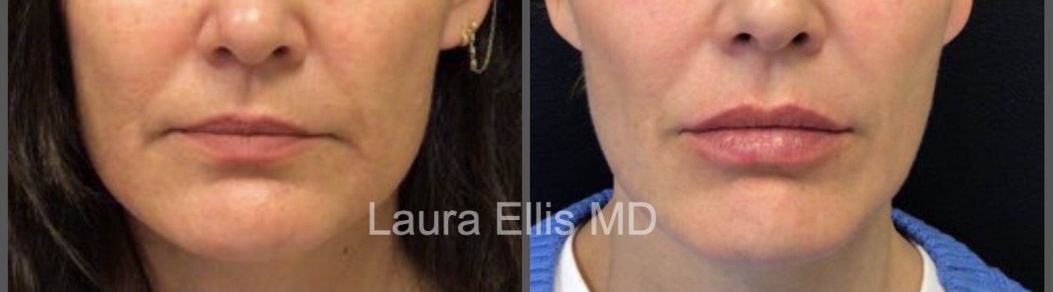 lip lines filler before after medAge-1