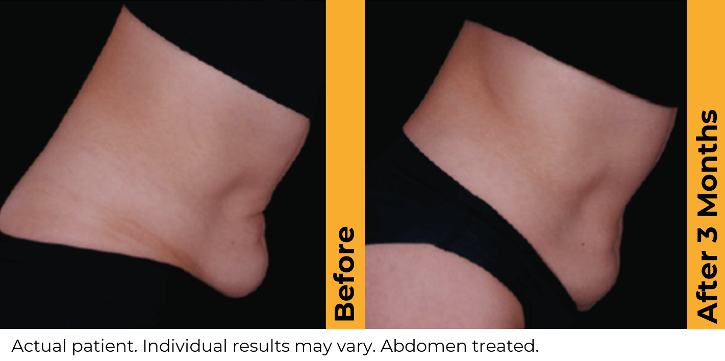 Ultherapy abdomen before and after profile view