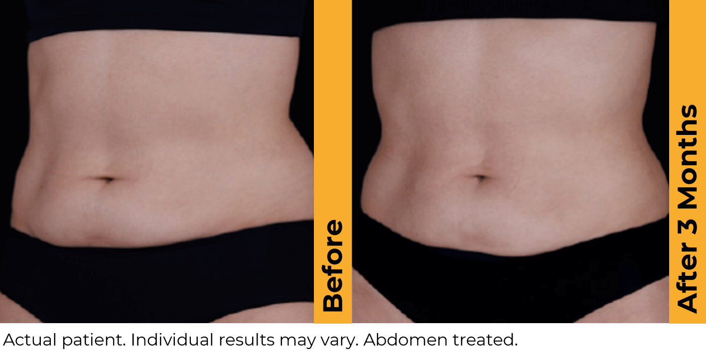 Ultherapy abdomen before and after