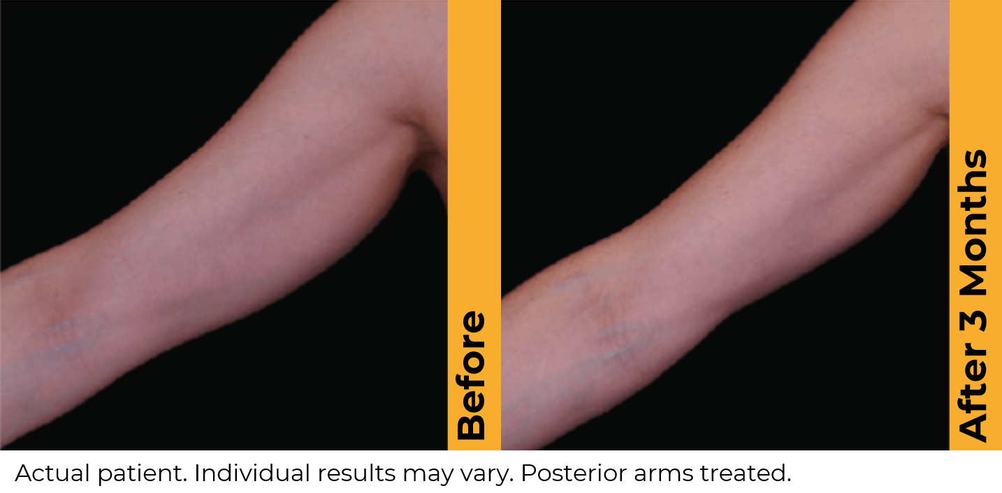 Ultherapy arms before and after