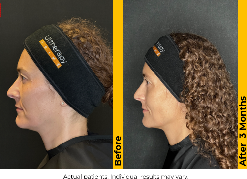 Ultherapy Before and After Photo