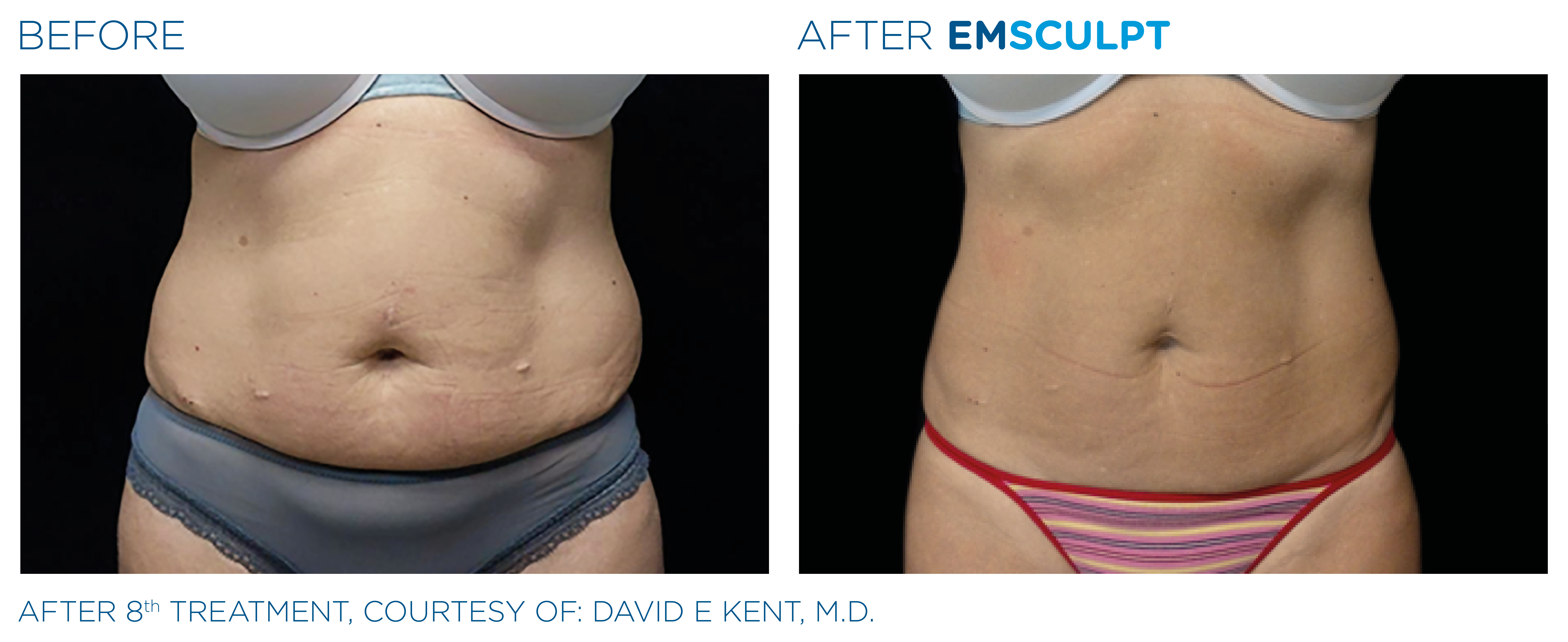 Emsculpt before and after abdomen — medAge Asheville