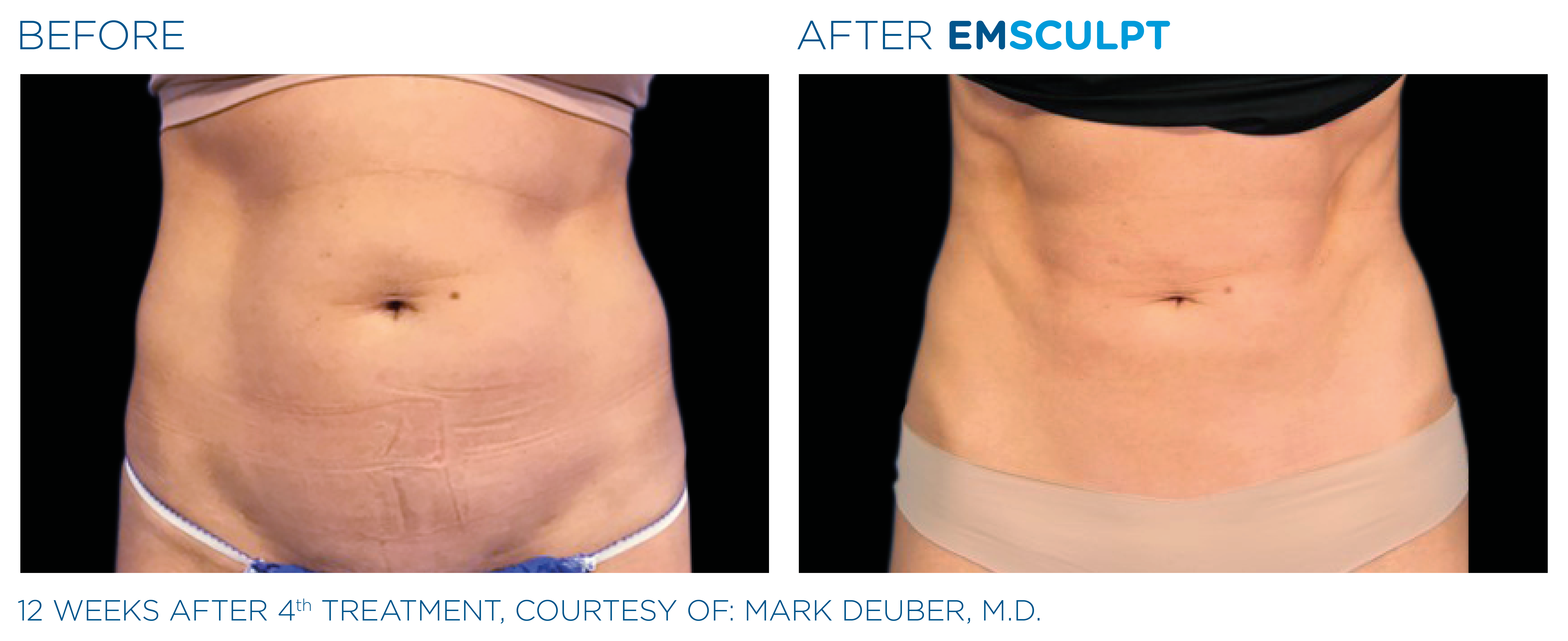 Emsculpt before and after abdomen — medAge Asheville