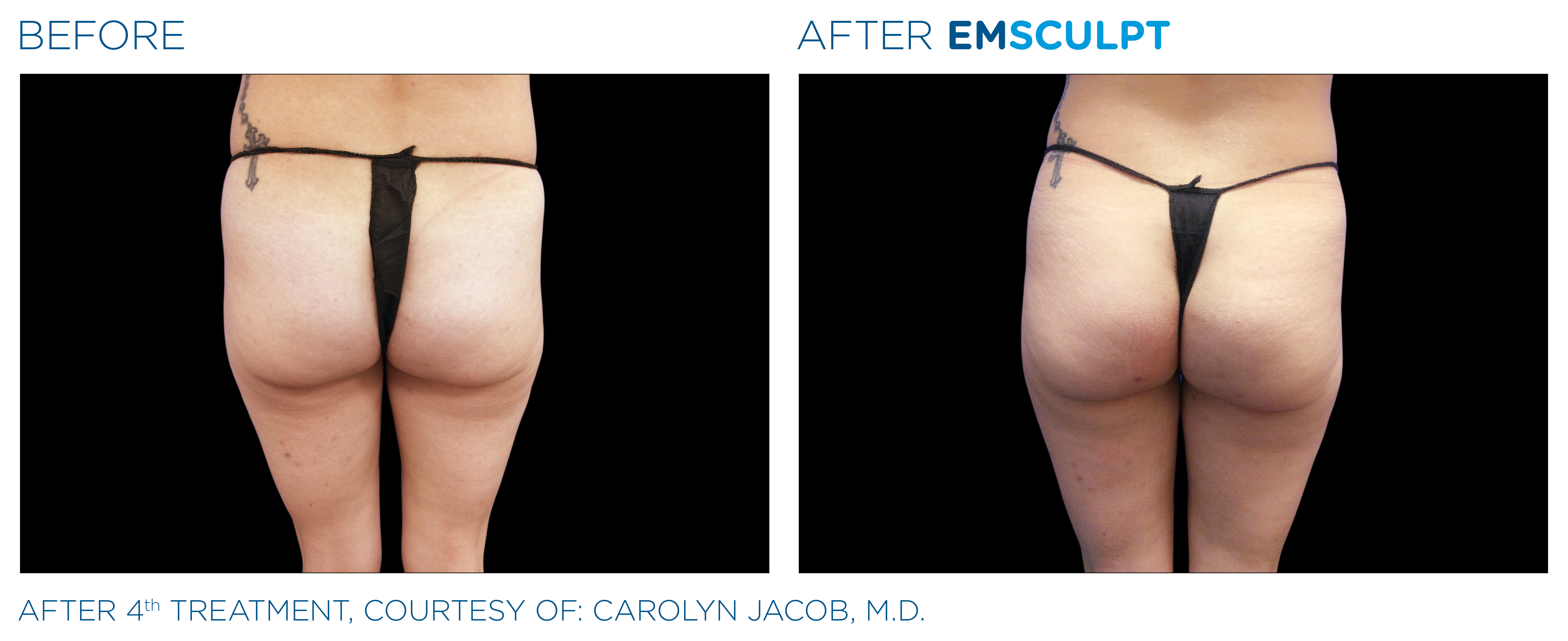 Emsculpt before and after buttocks — medAge Asheville