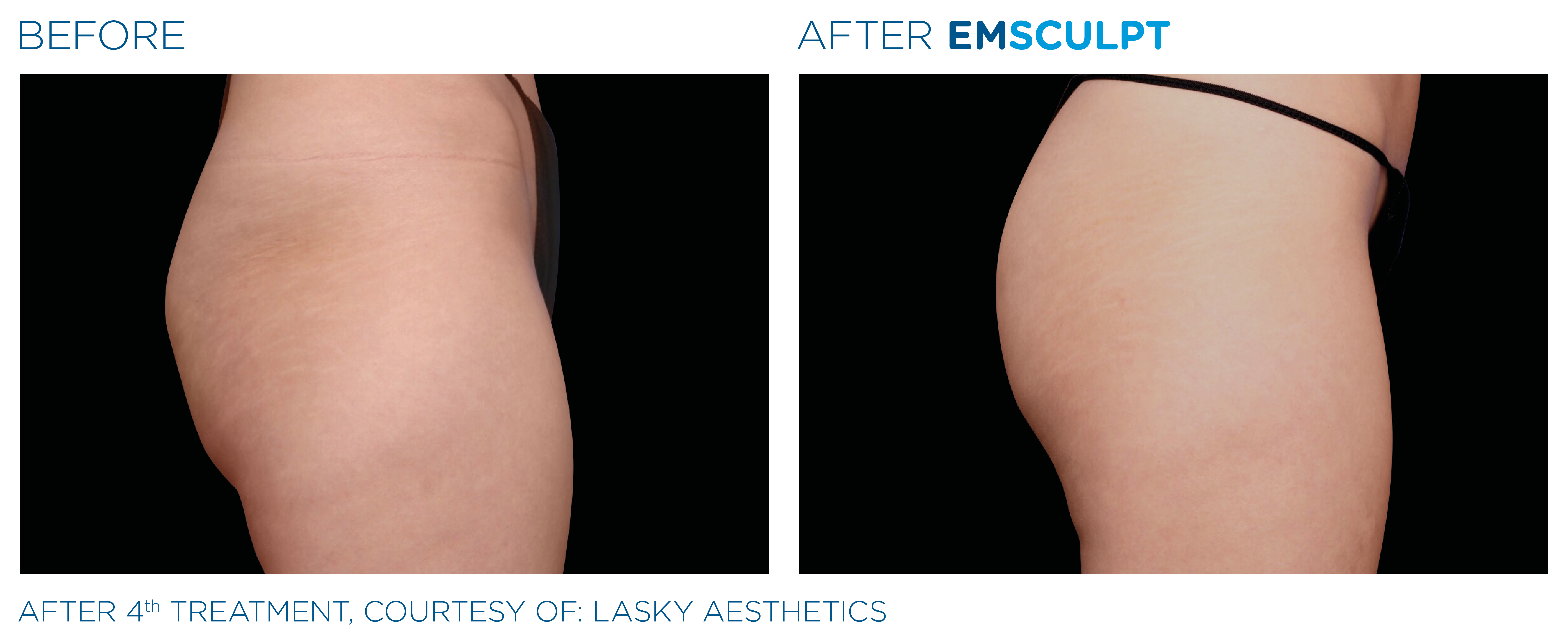 Emsculpt before and after buttocks — medAge Asheville
