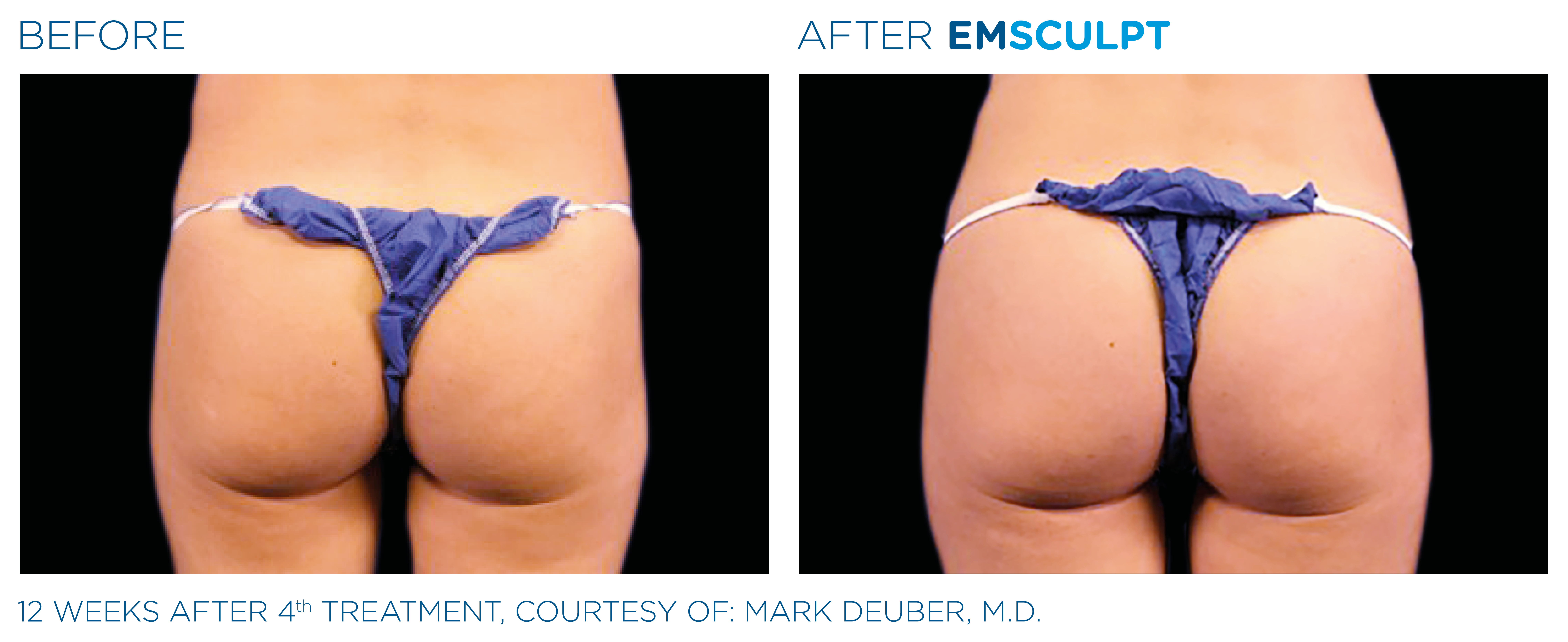 Emsculpt before and after buttocks — medAge Asheville